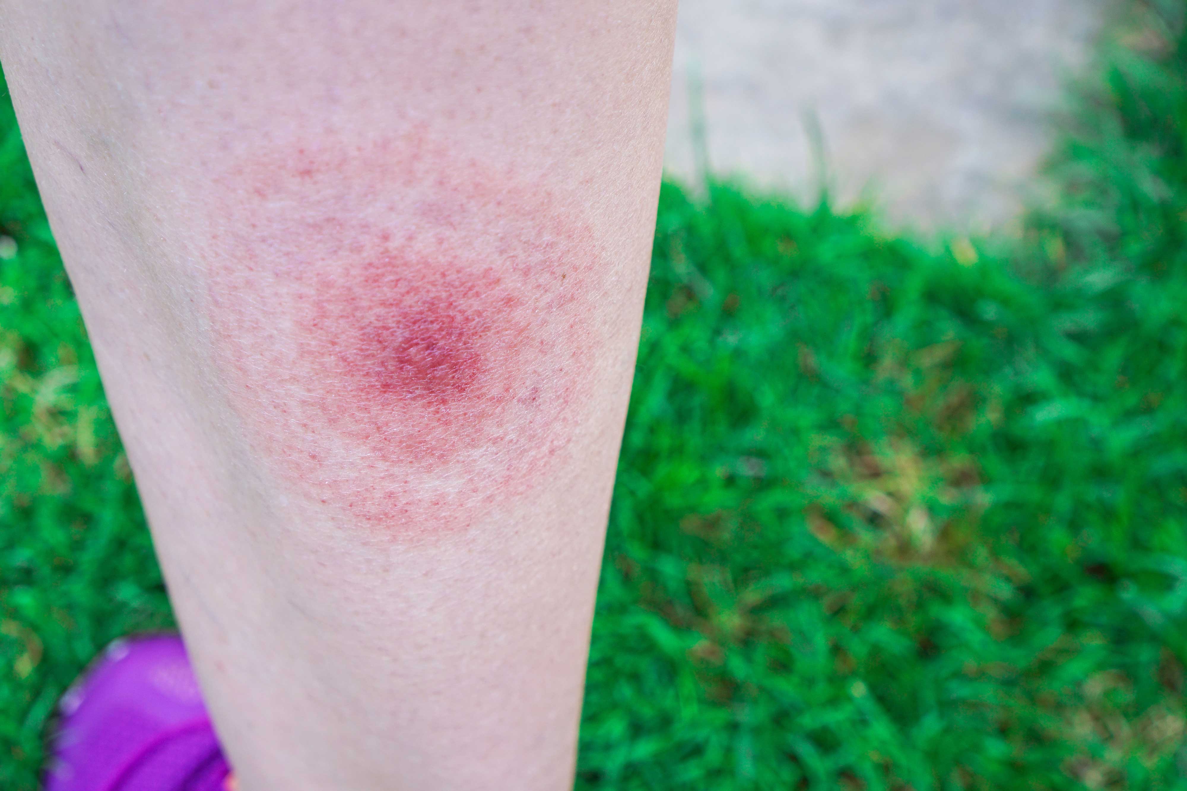 A bullseye-shaped rash on human skin.