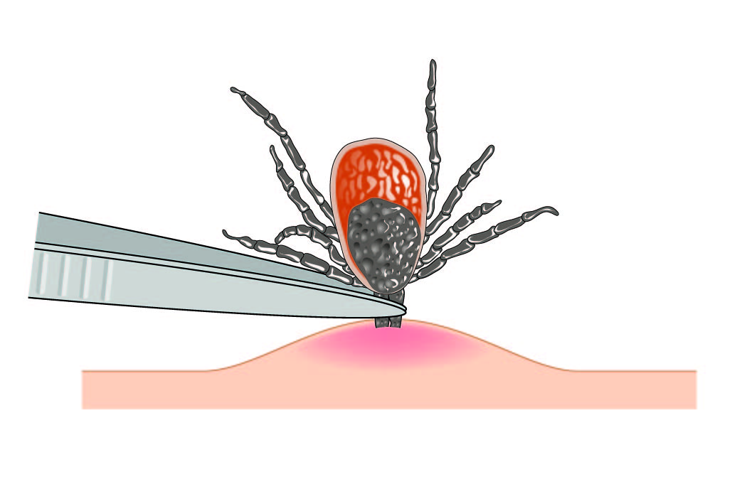An illustration showing how to remove a tick from the skin.